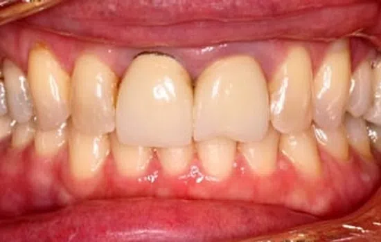 Close-up of misaligned upper and lower teeth with visible gum redness and dental plaque buildup.