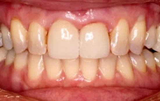 Close-up of human teeth and gums showing natural tooth color and healthy gums.