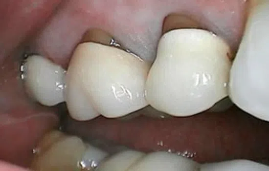 Close-up of upper molar teeth with dental crowns inside a human mouth.