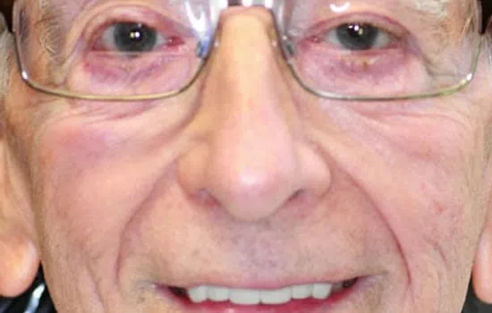 Senior man smiling showing natural teeth and close-up of new dental implants in the lower jaw.