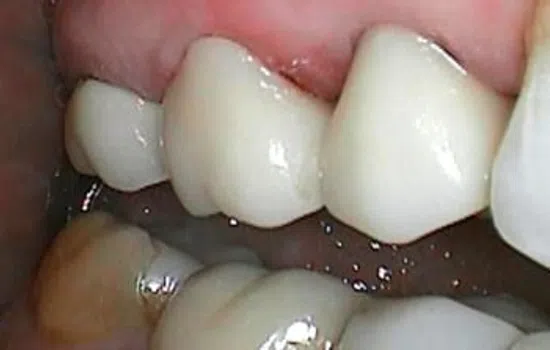 Close-up of teeth showing dental crowns and natural molars with shiny surfaces inside a mouth.