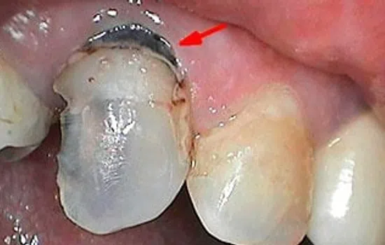 Close-up of a damaged tooth with a dental crown margin showing recession and gum inflammation indicated by a red arrow