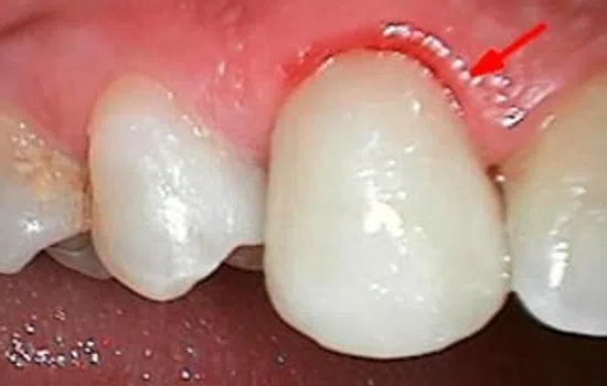 Close-up of upper front teeth showing inflamed gum with red arrow indicating gum irritation or infection.