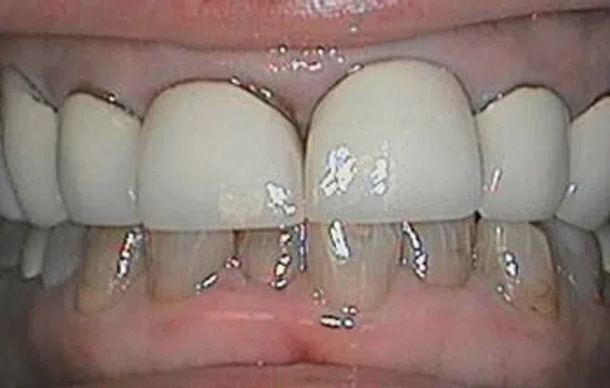 Close-up of upper teeth with dental crowns and some natural stained lower teeth visible.