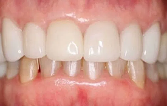 Close-up of a dental bridge with missing lower front teeth and gums visible beneath.