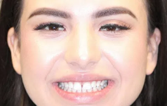 Before and after images showing a person’s teeth with gaps and after dental treatment, smiling widely.