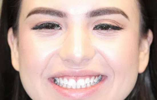 Close-up of a smiling woman with well-aligned white teeth shown in two perspectives.
