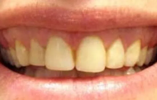 Close-up of a smile showing slightly yellowed upper teeth with natural lips and gums.