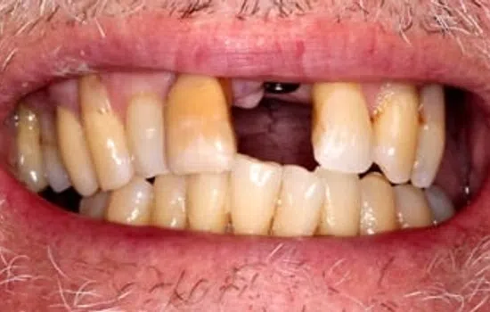 Close-up of a mouth with missing and discolored teeth showing poor dental health.