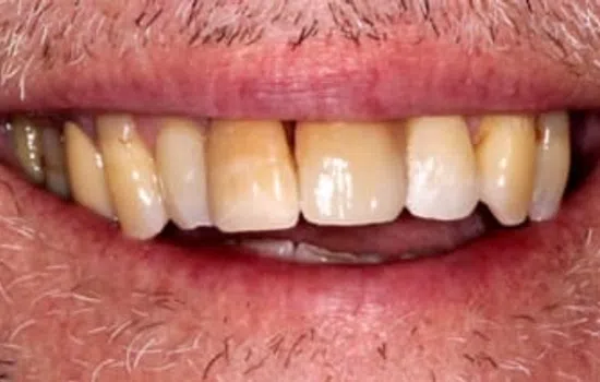 Close-up of discolored, uneven teeth with visible plaque and dental stains on older adult mouth.