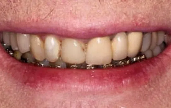 Close-up of lips showing uneven, yellowed teeth with metal braces on the lower teeth.