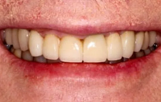Close-up of a smiling mouth showing clean, white, well-aligned teeth with natural lips and skin texture.