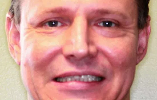 Before and after close-up photos showing dental transformation with improved teeth alignment and whiteness.