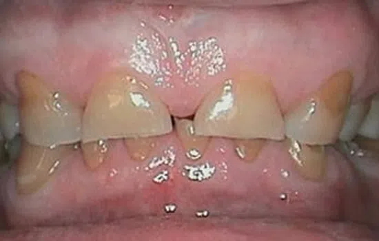 Close-up of severely decayed and broken front teeth with discoloration and gum redness.