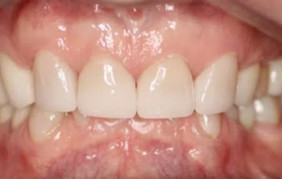 Close-up of upper and lower teeth showing dental restoration with crowns on front teeth.