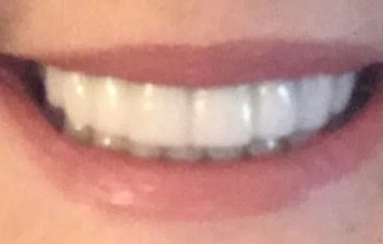 Close-up of a smiling mouth showing white, straight teeth and natural pink lips.