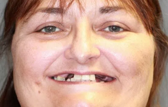 Close-up of a woman's face showing missing and damaged teeth before dental treatment.
