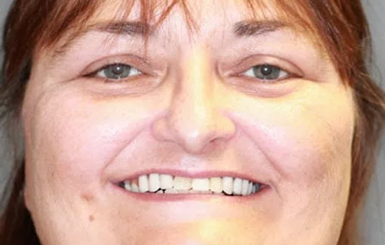Close-up of a smiling woman showing her teeth with a before and after dental treatment comparison.