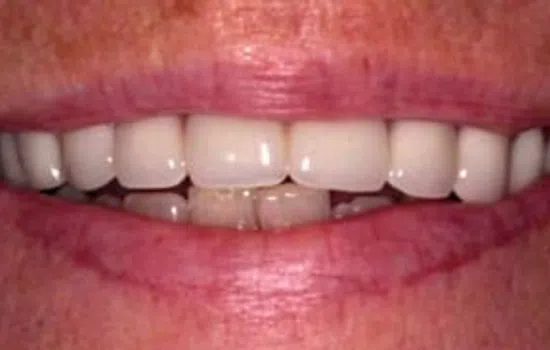 Close-up of a smiling mouth showing clean, white, aligned teeth and natural lips.