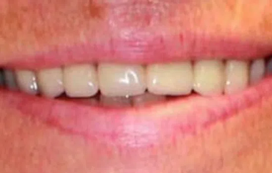 Close-up of a smiling mouth showing slightly yellowed upper front teeth and pink lips.