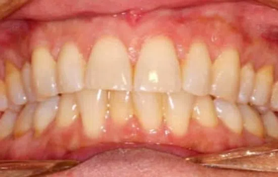 Close-up of a healthy human mouth showing aligned upper and lower teeth and gums