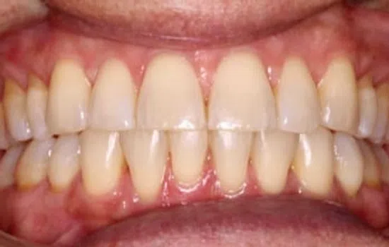 Close-up of healthy human teeth with visible gums in a natural smile, showing upper and lower teeth.