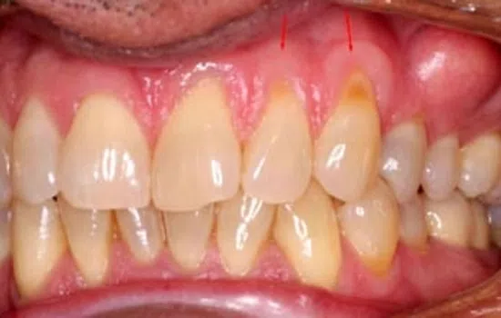 Close-up of teeth showing gum recession and yellow discoloration on upper front teeth.