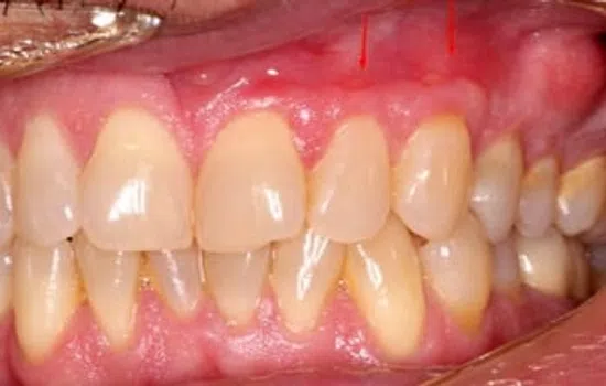 Close-up of human teeth showing mild gum recession and plaque buildup on lower front teeth.