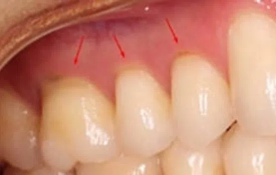 Close-up of teeth and gums with red arrows pointing to receding gum tissue above teeth.