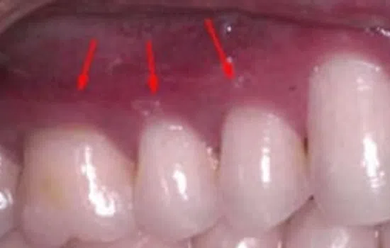 Close-up of upper gums and teeth with red arrows pointing to swollen, inflamed gum tissue.