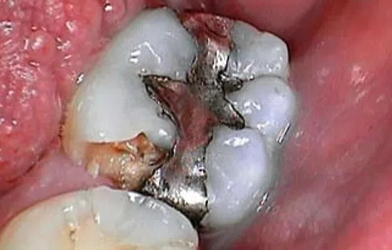 Close-up of molar teeth with metal dental filling and visible tooth decay in the mouth.