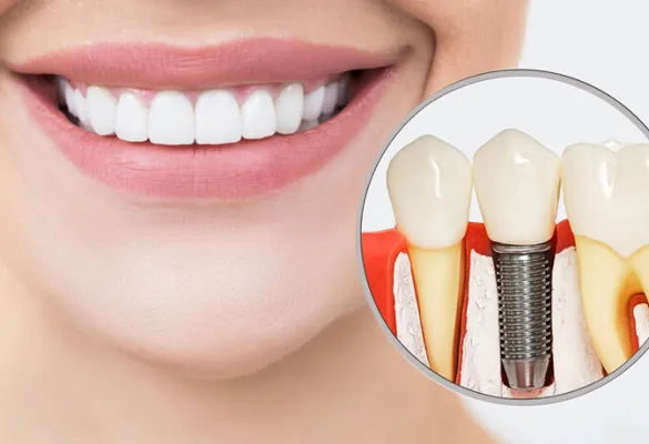 Close-up of a smiling mouth with white teeth and a magnified dental implant model showing jawbone and gums.