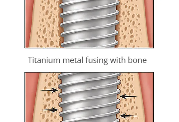 dental implant fusing to bone