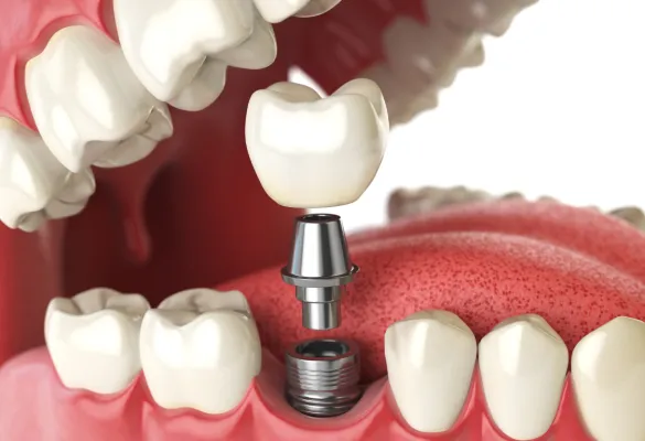 dental implant abutment and crown