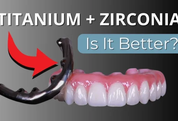 full mouth dental implants