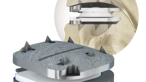 3D illustration of a spiked metal knee implant with a bone cross-section showing its placement.