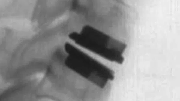 X-ray image of lumbar spine with two artificial intervertebral disc implants in place