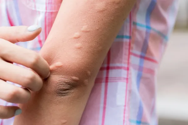 Nine Reasons Why Mosquitoes Love You