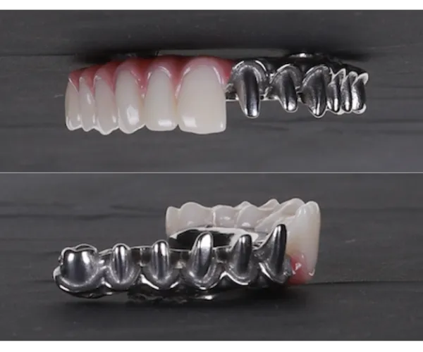 all on 4 implant hybrid denture with titanium bar