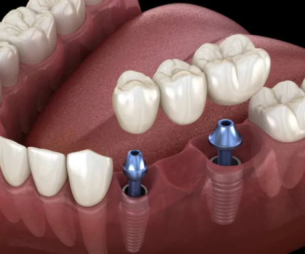 dental implant bridge