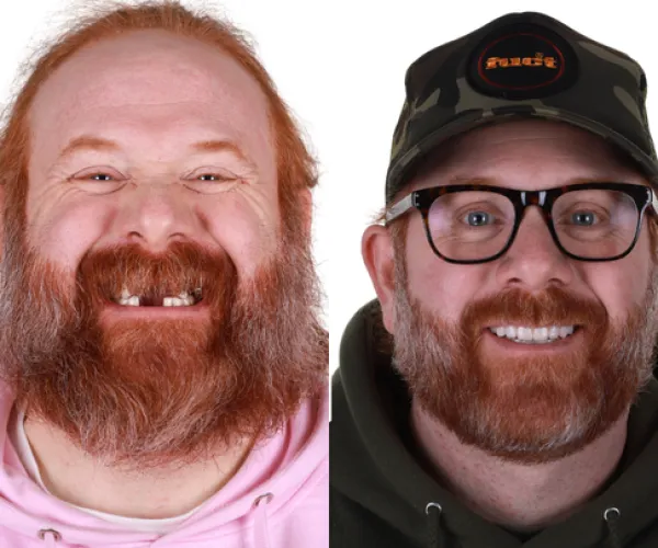 before and after smile transformation