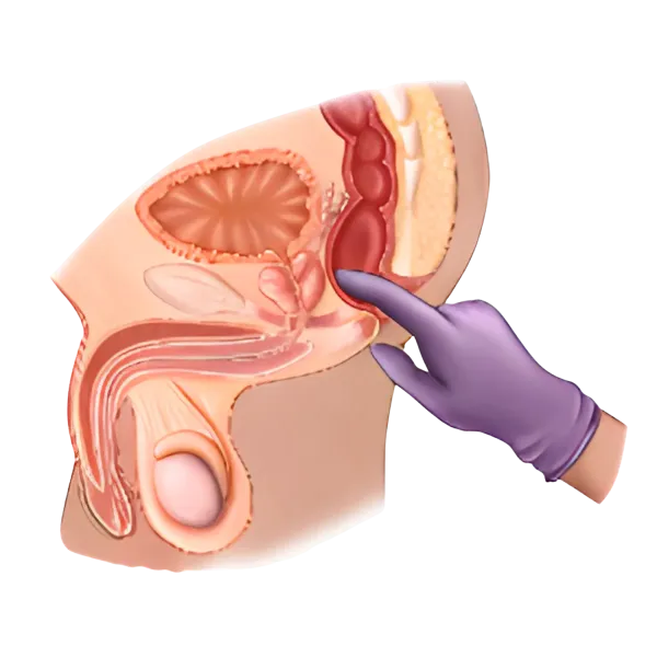 Medical illustration of a male pelvic cross-section with a gloved hand pointing at the rectum anatomy.