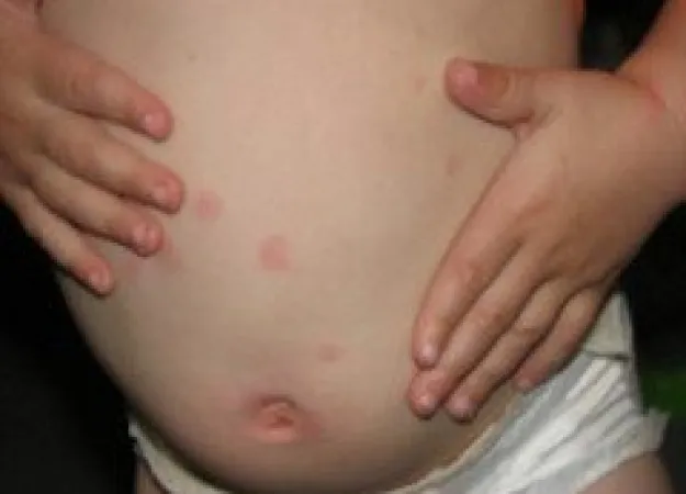 Urticaria treatment: what you need to know about this common reaction