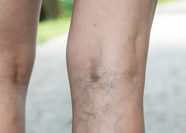 5 Facts about Varicose Veins