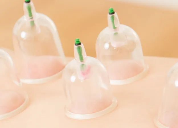 Cupping Therapy: What Is It and How Does it Work?