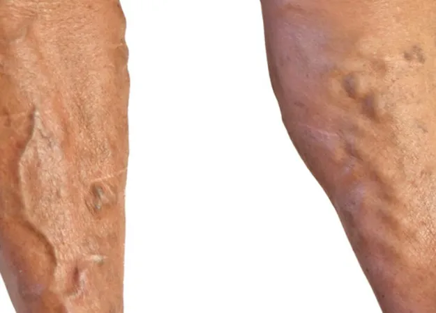 Varicose veins and men’s health