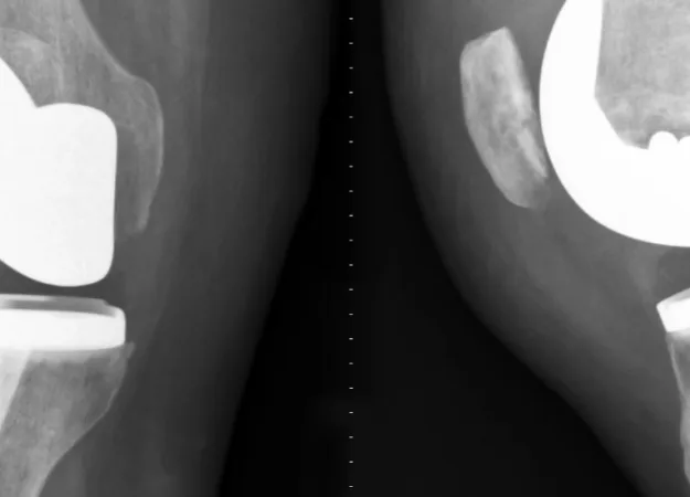 Treating and preventing a compression fracture of the spine