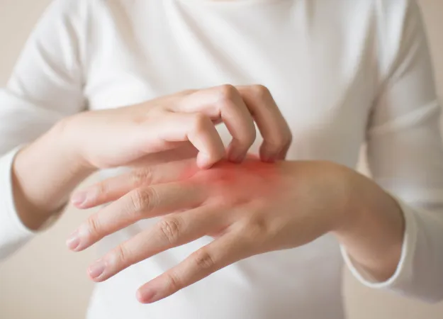 What is psoriasis?