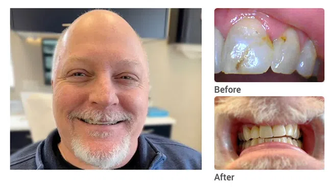 Smiling man with dental restoration showing before and after images of teeth cleaning and repair.