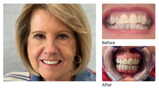 Smiling woman showing improved teeth after dental treatment with before and after close-up images of teeth.